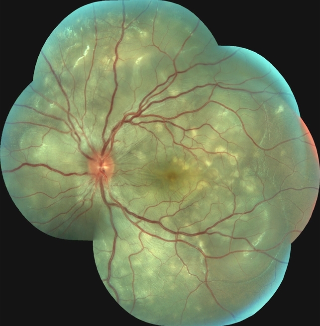 Vogt-Koyanagi-Harada Disease OS - Retina Image Bank