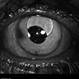 Silicone Oil Bubble in Anterior Chamber - 30 Degree Angle Silicone Oil Bubble in Anterior Chamber - 30 Degree Angle