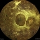 Tractional retinal detachment  in a case of proliferative diabetic retinopathy Tractional retinal detachment  in a case of proliferative diabetic retinopathy