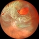 Retina Detachment