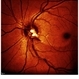 Colorized BR Disc Heme Wedge Defect Colorized BR Disc Heme Wedge Defect