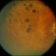 Macroaneurysm with Laser Macroaneurysm with Laser