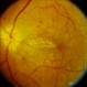 Hypertensive Retinopathy