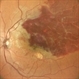 Branch Retinal Vein Occlusion with Macular Edema Branch Retinal Vein Occlusion with Macular Edema