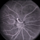 Autosomal Dominant Preretinal Vascular Loops Autosomal Dominant Preretinal Vascular Loops
