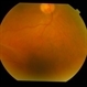 Bilateral Senile Retinoschisis