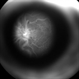 External Image of a Patient with CRVO Undergoing FFA
