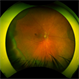 Serous Choroidal Detachment Serous Choroidal Detachment