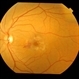 Perifoveal Telangiectasia With CNVM