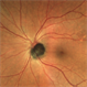Optic Disc Melanocytoma Optic Disc Melanocytoma