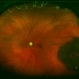 Adenocarcinoma Arising from CHRPE Adenocarcinoma Arising from CHRPE