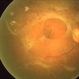 Diabetic Tractional Retinal Detachment Diabetic Tractional Retinal Detachment