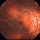 Sunset Glow Fundus Sunset Glow Fundus