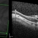 Vitreoschisis Vitreoschisis