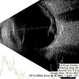 Tractional retinal detachment