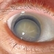 Anteriorly Dislocated Crystalline Lens Anteriorly Dislocated Crystalline Lens