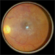 Epiretinal Membrane : Smartphone Fundus Image Epiretinal Membrane : Smartphone Fundus Image