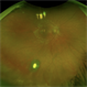 Intravitreal Parasitic Cyst