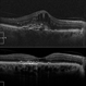 Fibrovascular PED Fibrovascular PED