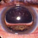 Retained perfluorocarbon in the anterior segment Retained perfluorocarbon in the anterior segment