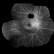 Subretinal Hemorrhage Secondary to Macroaneurysm