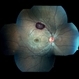 Subretinal Hemorrhage Secondary to Macroaneurysm