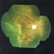 Uveal Effusion Syndrome Uveal Effusion Syndrome