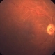 Macular Ischemia Macular Ischemia