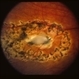 Laser Around Posterior Perforation Laser Around Posterior Perforation