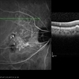 Polypoidal Choroidal Vasculopathy: Case 1 - Image 7 of 7 Polypoidal Choroidal Vasculopathy: Case 1 - Image 7 of 7