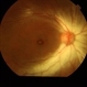 Macular Hole With Myelinated Fibers L CF OD January 31, 2014 Macular Hole With Myelinated Fibers L CF OD January 31, 2014