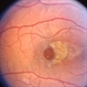 Traumatic macular hole Traumatic macular hole