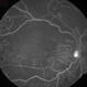 Macular Ischemia Macular Ischemia
