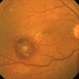 Retinal Arterial Macroaneurysm Retinal Arterial Macroaneurysm