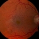 Macular Pucker Colour Macular Pucker Colour