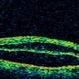 Macular Detachment from Multiple Myeloma Macular Detachment from Multiple Myeloma