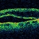 Macular Detachment from Multiple Myeloma Macular Detachment from Multiple Myeloma
