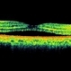 Posterior Scleritis Posterior Scleritis