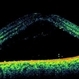 Posterior Scleritis Posterior Scleritis