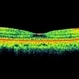 Posterior Scleritis Posterior Scleritis