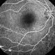 Marked Retinal Ischemia in Patient with Mixed Connective Tissue Disease Marked Retinal Ischemia in Patient with Mixed Connective Tissue Disease