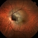 Melanocytoma with Choroidal Melanoma Melanocytoma with Choroidal Melanoma