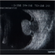 Melanoma-B-Mode Ultrasonography Melanoma-B-Mode Ultrasonography
