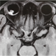 Melanoma-MRI-W1 Melanoma-MRI-W1