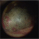 Melanoma-Fundus Melanoma-Fundus