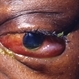 Metastatic orbital cancer Metastatic orbital cancer