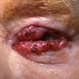 Metastatic malignant melanoma Metastatic malignant melanoma