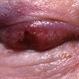 Metastatic malignant melanoma Metastatic malignant melanoma