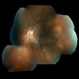 Bilateral Metastatic Lesions Secondary to Breast Cancer Bilateral Metastatic Lesions Secondary to Breast Cancer