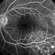 Bilateral Metastatic Lesions Secondary to Breast Cancer Bilateral Metastatic Lesions Secondary to Breast Cancer